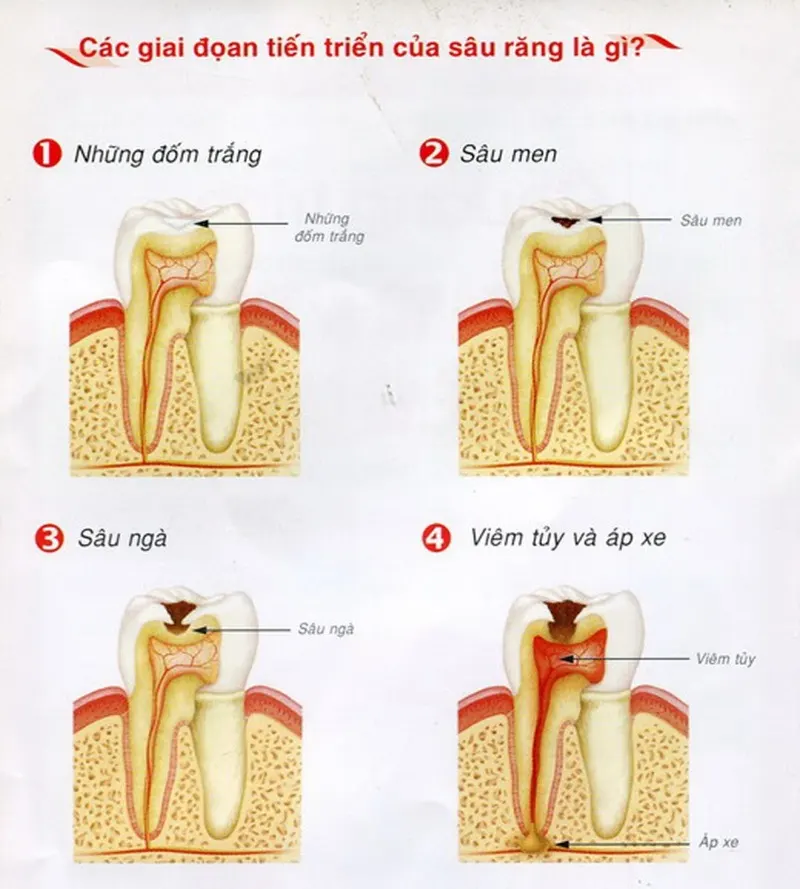 Các giai đoạn của sâu răng
