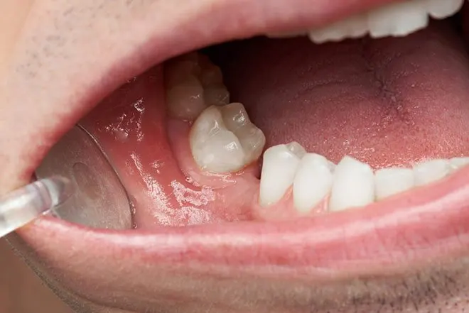 Sâu răng do vi khuẩn