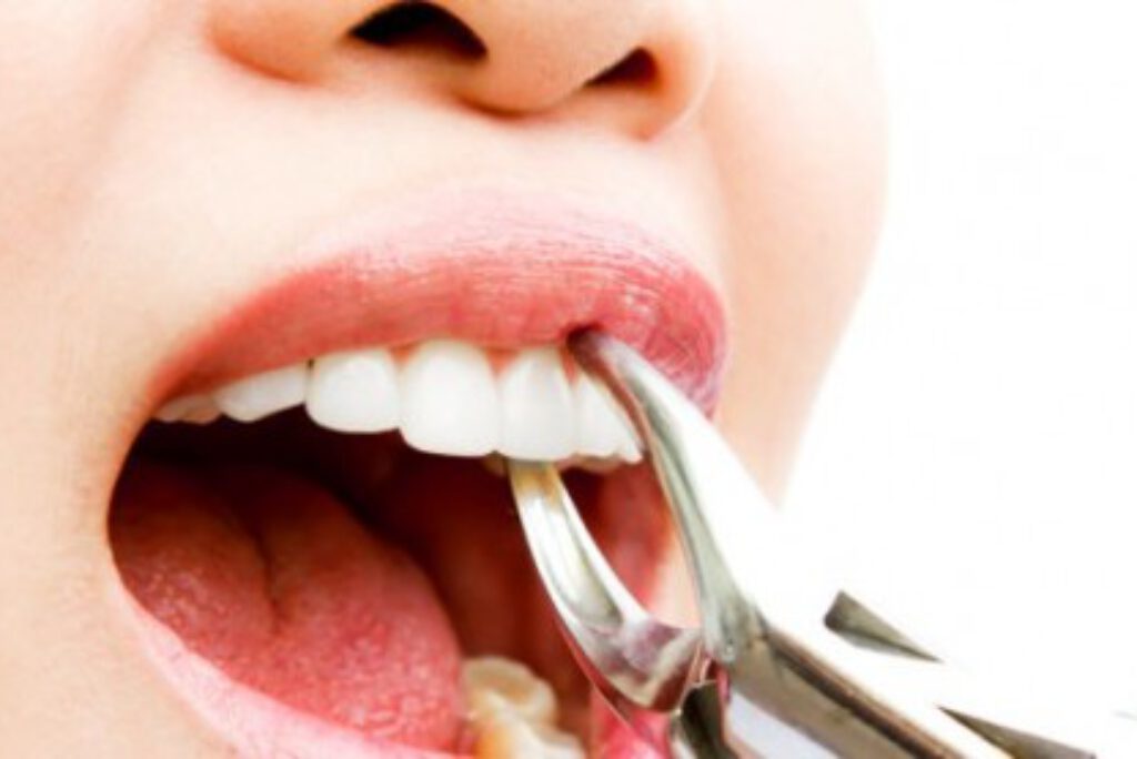 10 điều cần biết khi đi nhổ răng