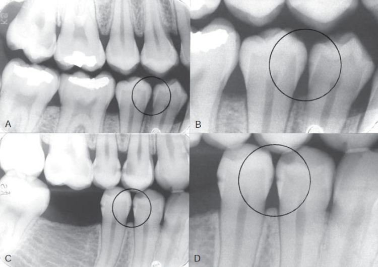 Vai trò của chụp X-quang trong chẩn đoán, điều trị bệnh răng miệng
