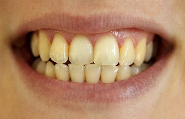 Nên tẩy trắng răng tại nhà hay phòng khám nha khoa?