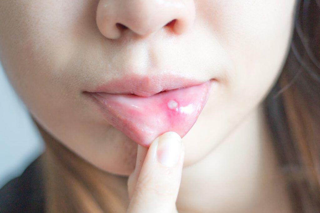 Cách chữa nhiệt miệng lâu ngày không khỏi: Hiểu rõ nguyên nhân để điều trị hiệu quả