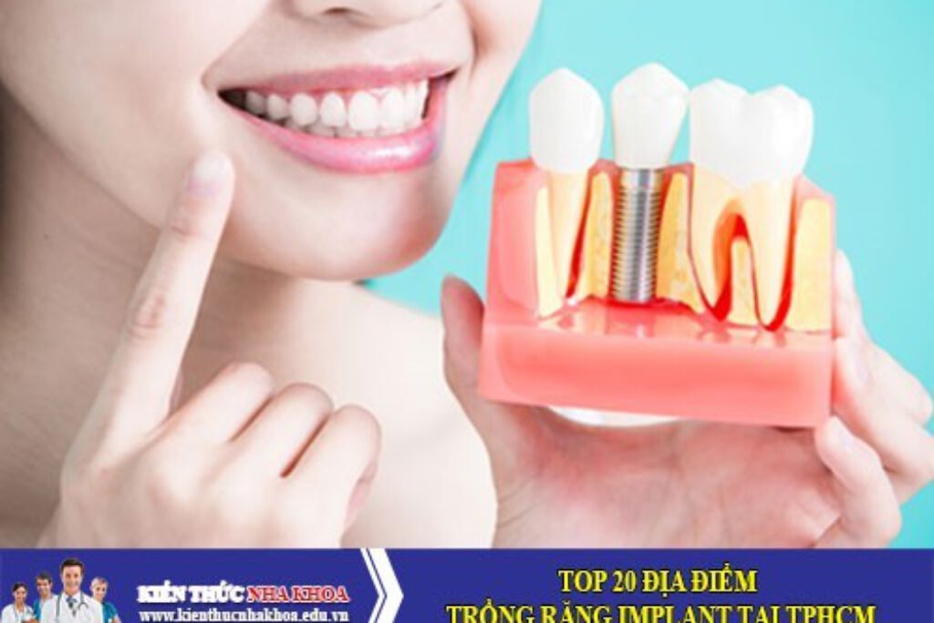 TOP 20 Địa Điểm Trồng Răng Implant Tại TPHCM