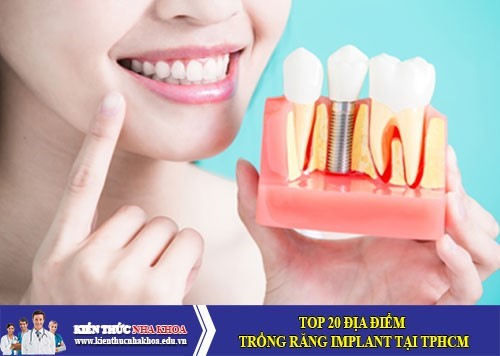 TOP 20 Địa Điểm Trồng Răng Implant Tại TPHCM