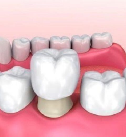 Mòn cổ răng – Bệnh lý nha khoa phổ biến nhưng dễ bị bỏ qua