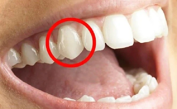 Con người có bao nhiêu cái răng? 