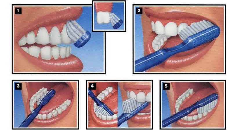 vôi răng là gì? Những tác hại chính của vôi răng