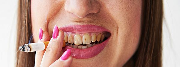 5 Cách lấy cao răng đen hiệu quả nhất