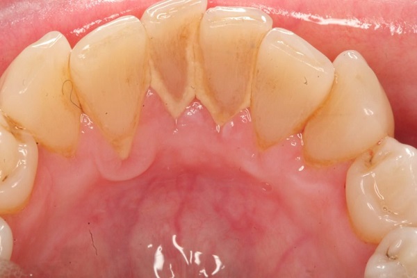 7 cách làm sao để không bị cao răng hiệu quả nhất 