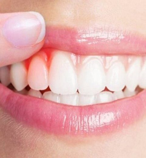 Mòn cổ răng – Bệnh lý nha khoa phổ biến nhưng dễ bị bỏ qua