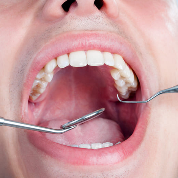 Chi phí nhổ răng khôn và tổng hợp tất cả về răng khôn