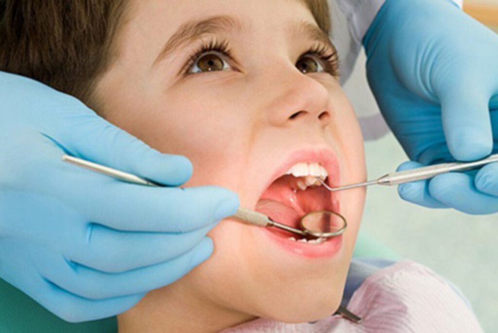 Có nên lấy cao răng cho trẻ không? Tác hại của cao răng đối với trẻ em